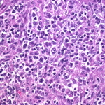 Diffuse large B cell lymphoma 